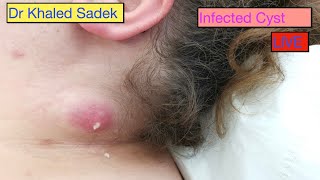 Epidermoid Cyst Removal INTACT Auburn Medical Group [upl. by Laud]