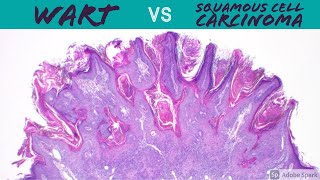 Wart vs Squamous Cell Carcinoma Dermpath Pathology Dermatology Verruca Seborrheic Keratosis SCC [upl. by Charline109]