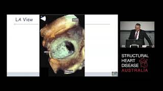 Imaging the IntraAtrial septum  Prof Gregory Scalia [upl. by Cassella]