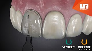 Uveneer® Procedure Animation  Direct Veneer Template System [upl. by Anneehs]