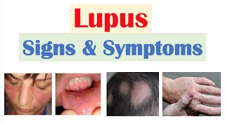 Systemic Lupus Erythematosus SLE Symptoms Diagnose And Treatment  Rheumatology [upl. by Ydaf293]