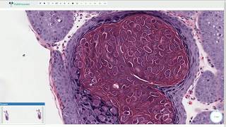 Molluscum Contagiosum  Histopathology [upl. by Sjoberg857]