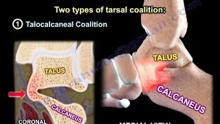 Tarsal Coalition  Everything You Need To Know  Dr Nabil Ebraheim [upl. by Nereus678]