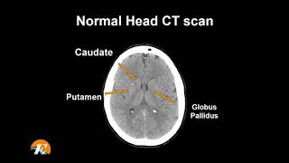 Stroke Syndromes MCA ACA ICA PCA Vertebrobasilar Artery Strokes  Pathophysiology [upl. by Chryste469]