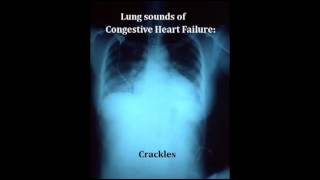 lung sounds  crackles [upl. by Arymat]