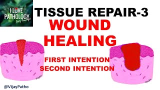 TISSUR REPAIR Part 3 WOUND HEALING Factors affecting wound healing [upl. by Akihsal366]