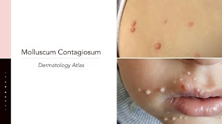 Molluscum Contagiosum [upl. by Carbone]