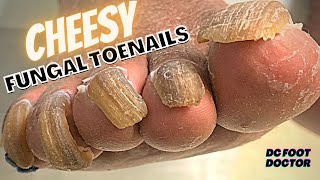 Cheesy Fungal Toenails Trimming Long Toenails [upl. by Trebornhoj]