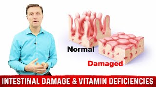 Intestinal Obstruction amp Vitamin Deficiencies – Dr Berg [upl. by Teresa]