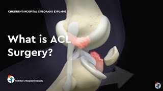 ACL surgery Graft options [upl. by Ynned711]