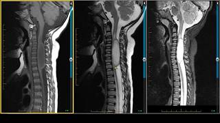 Cervical Spinal Cord Astrocytoma on MRI [upl. by Ennoirb328]