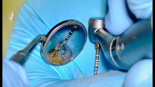 Root Canal Procedure  Top 5 Secrets [upl. by Amilb363]