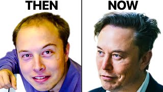 Elon Musks Hair Transplant  Surgeon Reacts [upl. by Supen]