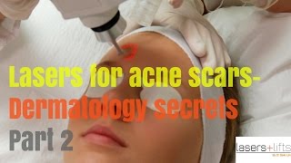 Laser Resurfacing for ACNE SCARS Secrets revealed [upl. by Ingold]