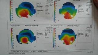 Corneal topography explained [upl. by Hilliary]