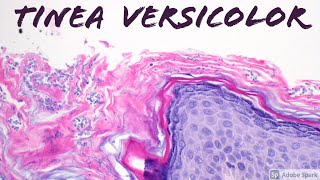 Tinea VersicolorPityriasis Versicolor Malassezia aka Pityrosporum Skin Infection Dermatology [upl. by Hpesoj]