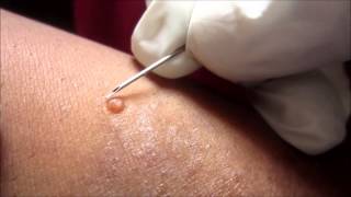 Removing H P Body From Molluscum Contagiosum [upl. by Enelaehs685]