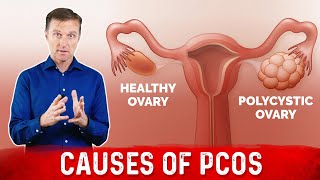 Natural way to treat Polycystic ovarian syndrome PCOSPCOD  Dr Vivek Joshi [upl. by Flavia]