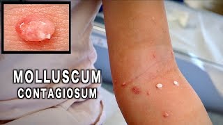 UNUSUAL MOLLUSCUM CONTAGIOSUM Treated with Cryotherapy  Dr Paul [upl. by Arateehc442]