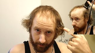 BALDING MAN Shaves Head Bald TOTALLY TRANSFORMING His Look [upl. by Vola]