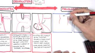 Bowel Obstruction  Causes and Pathophysiology [upl. by Shabbir413]