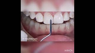 Composite Veneers step by step  All the Secrets [upl. by Akinot]