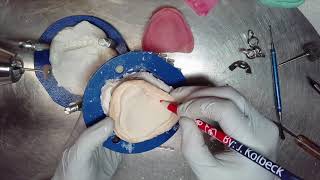 Cold Cure Complete Denture Reline With Jig [upl. by Ignatius]