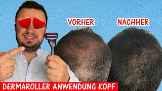 Dermaroller Gegen Haarausfall  So gehts [upl. by Butch560]