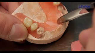 Thermoplastic dentures  Repair and service [upl. by Barrada]