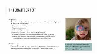 Intermittent Exotropia Management [upl. by Paule]