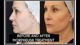 BEFORE AND AFTER MY MORPHEUS 8 TREATMENT [upl. by Dnalra]