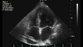 Interatrial septal aneurysm [upl. by Aw]