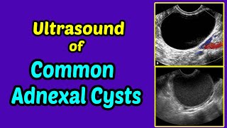 Management of RadiationInduced Hemorrhagic Cystitis [upl. by Ednutabab]