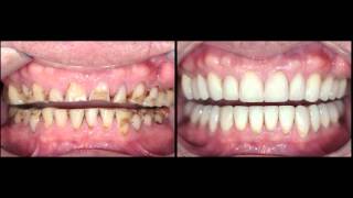 Full mouth rehabilitation for advanced tooth wear case study by Dr Stephen Phelan [upl. by Eilitan766]