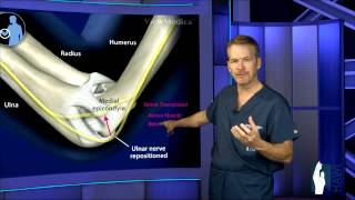 Cubital Tunnel Surgery [upl. by Rivera]