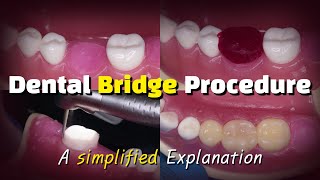 Dental Bridge Procedure [upl. by Iveksarap196]