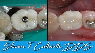 Securing Loose Implant Crown  Dental Minute with Steven T Cutbirth DDS [upl. by Ihp404]