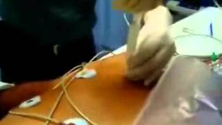 Toracocentesis con aguja en Neumotorax a tensionwmv [upl. by Farrah]