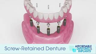 Demo How Do ImplantSecured Removable Dentures Work [upl. by Amedeo411]