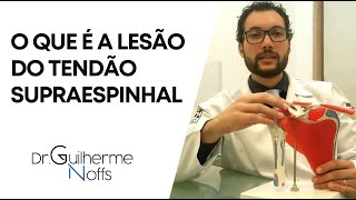 Lesão do Tendão Supraespinhal  Dr Guilherme Noffs [upl. by Cirdes]