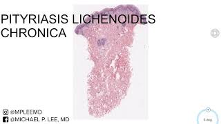 Pityriasis Lichenoides Chronica Dermpath Made Easy [upl. by Tloc951]