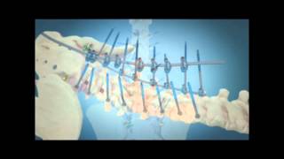 Scoliosis Surgical Correction with Instrumentation [upl. by Lina317]